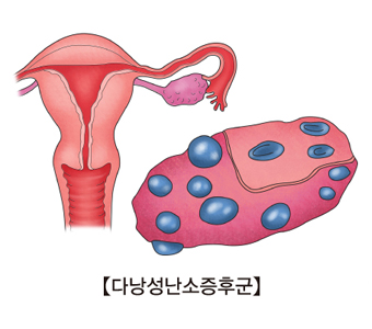 다낭성 난소 증후군